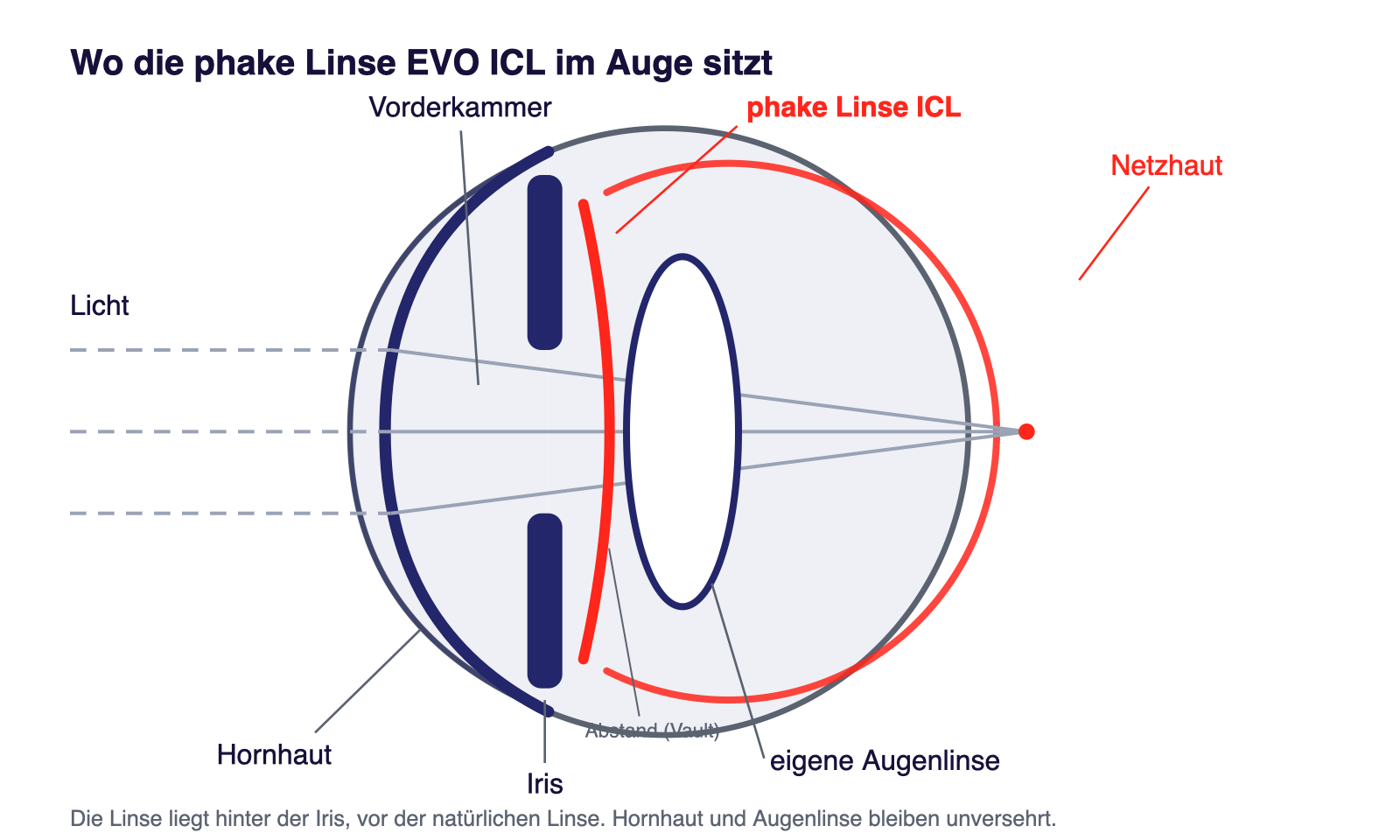 Schema: Lage der phaken Linse EVO ICL im Auge – hinter der Iris, vor der eigenen Augenlinse; Hornhaut unversehrt