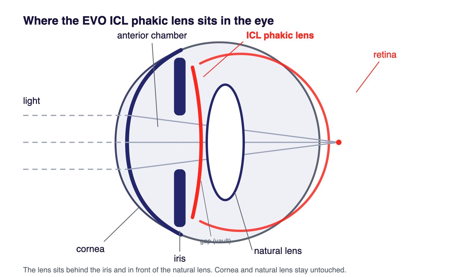 Diagram: position of the EVO ICL phakic lens in the eye – behind the iris, in front of the natural lens; cornea untouched