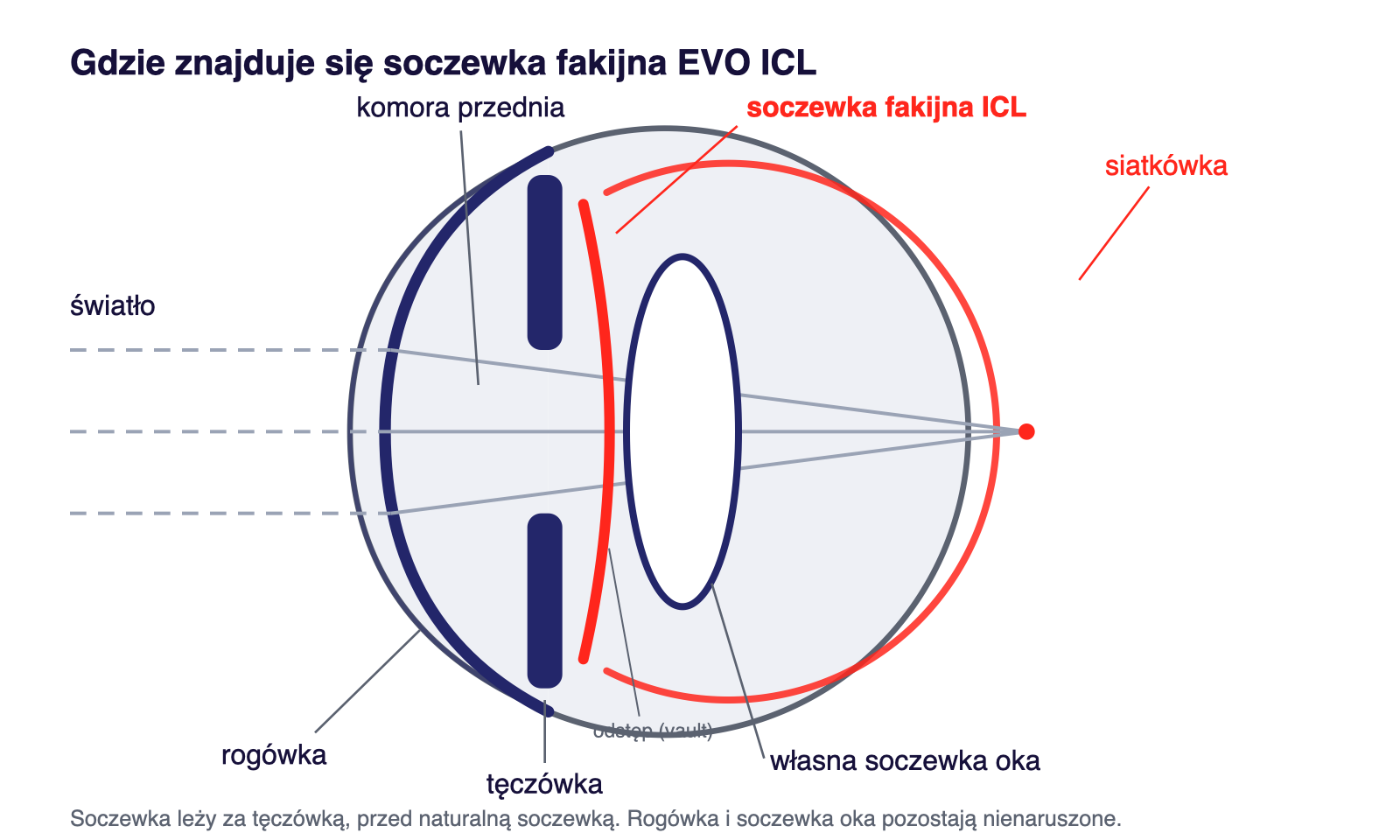 Schemat: położenie soczewki fakijnej EVO ICL w oku – za tęczówką, przed własną soczewką; rogówka nienaruszona